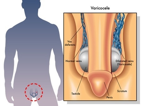 Should Varicocele Be Treated? What Happens If Surgery Is Not Performed?